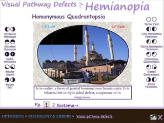 1Pg. 2 Scotoma→
Normal Field
Total Homonymous
Hemianopia
Partial Homonymous
Hemianopia
Homonymous
Quadrantopsia
Crossed
Quadrantopsia
Binasal
Hemianopia
Bitemporal
Hemianopia
Altitudinal
Hemianopia
Double
Hemianopia
Macular
Spared
Macular
Split
Homonymous Quadrantopsia
Is in reality, a form of partial homonymous hemianopia. It is
bilateral left or right sided defect, congruous or in
congruous
L.E field R.E field
 