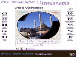 1Pg. 2 Scotoma→
Normal Field
Total Homonymous
Hemianopia
Partial Homonymous
Hemianopia
Homonymous
Quadrantopsia
Crossed
Quadrantopsia
Binasal
Hemianopia
Bitemporal
Hemianopia
Altitudinal
Hemianopia
Double
Hemianopia
Macular
Spared
Macular
Split
Crossed Quadrantopsia
Is a defect in visual field in which an upper quadrant of one
field is lost long with the lower quadrant in opposite side of
opposite field.
L.E field R.E field
 