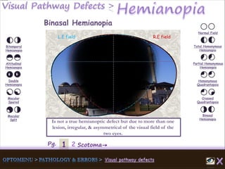 1Pg. 2 Scotoma→
Normal Field
Total Homonymous
Hemianopia
Partial Homonymous
Hemianopia
Homonymous
Quadrantopsia
Crossed
Quadrantopsia
Binasal
Hemianopia
Bitemporal
Hemianopia
Altitudinal
Hemianopia
Double
Hemianopia
Macular
Spared
Macular
Split
Binasal Hemianopia
Is not a true hemianoptic defect but due to more than one
lesion, irregular, & asymmetrical of the visual field of the
two eyes.
L.E field R.E field
 