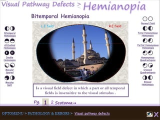 1Pg. 2 Scotoma→
Normal Field
Total Homonymous
Hemianopia
Partial Homonymous
Hemianopia
Homonymous
Quadrantopsia
Crossed
Quadrantopsia
Binasal
Hemianopia
Bitemporal
Hemianopia
Altitudinal
Hemianopia
Double
Hemianopia
Macular
Spared
Macular
Split
Bitemporal Hemianopia
Is a visual field defect in which a part or all temporal
fields is insensitive to the visual stimulus .
L.E field R.E field
 