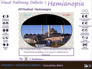 1Pg. 2 Scotoma→
Normal Field
Total Homonymous
Hemianopia
Partial Homonymous
Hemianopia
Homonymous
Quadrantopsia
Crossed
Quadrantopsia
Binasal
Hemianopia
Bitemporal
Hemianopia
Altitudinal
Hemianopia
Double
Hemianopia
Macular
Spared
Macular
Split
Altitudinal Hemianopia
Is a visual field defect which divided & bounded by
horizontal meridian, it is may be unilateral or
bilateral
L.E field R.E field
 