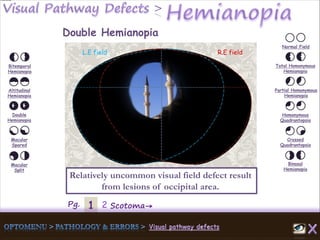 1Pg. 2 Scotoma→
Normal Field
Total Homonymous
Hemianopia
Partial Homonymous
Hemianopia
Homonymous
Quadrantopsia
Crossed
Quadrantopsia
Binasal
Hemianopia
Bitemporal
Hemianopia
Altitudinal
Hemianopia
Double
Hemianopia
Macular
Spared
Macular
Split
Double Hemianopia
Relatively uncommon visual field defect result
from lesions of occipital area.
L.E field R.E field
 