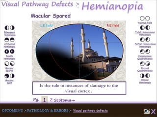 1Pg. 2 Scotoma→
Normal Field
Total Homonymous
Hemianopia
Partial Homonymous
Hemianopia
Homonymous
Quadrantopsia
Crossed
Quadrantopsia
Binasal
Hemianopia
Bitemporal
Hemianopia
Altitudinal
Hemianopia
Double
Hemianopia
Macular
Spared
Macular
Split
Macular Spared
Is the rule in instances of damage to the
visual cortex .
L.E field R.E field
 