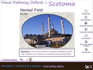 2←Hemianopia Pg. 1
Normal Field
Central Scotoma
Pericentral Scotoma
Paracentral Scotoma
Cecal Scotoma
Nerve Fiber Bundle
Scotoma
Ring ScotomaScotoma is an area of partial or complete blindness within
the confines of a normal or relatively normal visual field .
Normal Field
R.E field
 
