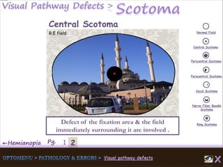 2←Hemianopia Pg. 1
Normal Field
Central Scotoma
Pericentral Scotoma
Paracentral Scotoma
Cecal Scotoma
Nerve Fiber Bundle
Scotoma
Ring ScotomaDefect of the fixation area & the field
immediately surrounding it are involved .
Central Scotoma
R.E field
 