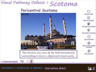 2←Hemianopia Pg. 1
Normal Field
Central Scotoma
Pericentral Scotoma
Paracentral Scotoma
Cecal Scotoma
Nerve Fiber Bundle
Scotoma
Ring Scotoma
Pericentral Scotoma
R.E field
The fixation area clear & the field immediately
surrounding it shows a depressed visual acuity .
 