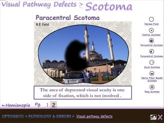 2←Hemianopia Pg. 1
Normal Field
Central Scotoma
Pericentral Scotoma
Paracentral Scotoma
Cecal Scotoma
Nerve Fiber Bundle
Scotoma
Ring Scotoma
Paracentral Scotoma
R.E field
The area of depressed visual acuity is one
side of fixation, which is not involved .
 