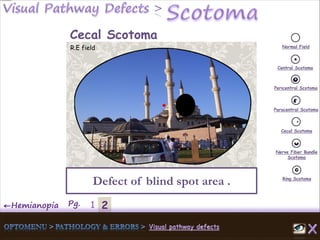 2←Hemianopia Pg. 1
Normal Field
Central Scotoma
Pericentral Scotoma
Paracentral Scotoma
Cecal Scotoma
Nerve Fiber Bundle
Scotoma
Ring Scotoma
Defect of blind spot area .
Cecal Scotoma
R.E field
 