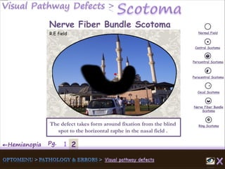 2←Hemianopia Pg. 1
Normal Field
Central Scotoma
Pericentral Scotoma
Paracentral Scotoma
Cecal Scotoma
Nerve Fiber Bundle
Scotoma
Ring ScotomaThe defect takes form around fixation from the blind
spot to the horizontal raphe in the nasal field .
Nerve Fiber Bundle Scotoma
R.E field
 