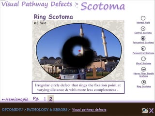 2←Hemianopia Pg. 1
Normal Field
Central Scotoma
Pericentral Scotoma
Paracentral Scotoma
Cecal Scotoma
Nerve Fiber Bundle
Scotoma
Ring ScotomaIrregular circle defect that rings the fixation point at
varying distance & with more less completeness .
Ring Scotoma
R.E field
 