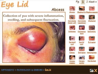 1 Next→Pg. 2
Abcess Blepharitis Blepharospasm
Carcinoma
'basal cell'
Carcinoma
'squamous'
Chalazion
Coloboma Cutaneous
horn
Deformity
Dermoid
cyst
Ductal
cyst
Ectropion
EntropionEdema Hemangioma
Herpes
simplex
Herpes
zoster
Hordeolum
Collection of pus with severe inflammation,
swelling, and subsequent fluctuation.
Abcess
 