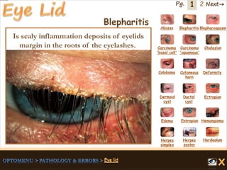 1 Next→Pg. 2
Blepharitis Abcess Blepharitis Blepharospasm
Carcinoma
'basal cell'
Carcinoma
'squamous'
Chalazion
Coloboma Cutaneous
horn
Deformity
Dermoid
cyst
Ductal
cyst
Ectropion
EntropionEdema Hemangioma
Herpes
simplex
Herpes
zoster
Hordeolum
Is scaly inflammation deposits of eyelids
margin in the roots of the eyelashes.
 