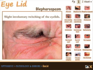 1 Next→Pg. 2
Blepharospasm Abcess Blepharitis Blepharospasm
Carcinoma
'basal cell'
Carcinoma
'squamous'
Chalazion
Coloboma Cutaneous
horn
Deformity
Dermoid
cyst
Ductal
cyst
Ectropion
EntropionEdema Hemangioma
Herpes
simplex
Herpes
zoster
Hordeolum
Slight involuntary twitching of the eyelids.
 