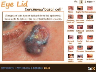 1 Next→Pg. 2
Carcinoma'basal cell' Abcess Blepharitis Blepharospasm
Carcinoma
'basal cell'
Carcinoma
'squamous'
Chalazion
Coloboma Cutaneous
horn
Deformity
Dermoid
cyst
Ductal
cyst
Ectropion
EntropionEdema Hemangioma
Herpes
simplex
Herpes
zoster
Hordeolum
Malignant skin tumor derived from the epidermal
basal cells & cells of the outer hair follicle sheaths.
 