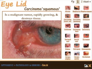 1 Next→Pg. 2
Carcinoma'squamous' Abcess Blepharitis Blepharospasm
Carcinoma
'basal cell'
Carcinoma
'squamous'
Chalazion
Coloboma Cutaneous
horn
Deformity
Dermoid
cyst
Ductal
cyst
Ectropion
EntropionEdema Hemangioma
Herpes
simplex
Herpes
zoster
Hordeolum
Is a malignant tumor, rapidly growing, &
destroys tissue.
 