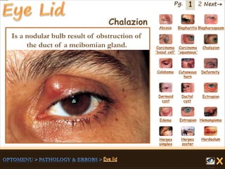 1 Next→Pg. 2
Chalazion Abcess Blepharitis Blepharospasm
Carcinoma
'basal cell'
Carcinoma
'squamous'
Chalazion
Coloboma Cutaneous
horn
Deformity
Dermoid
cyst
Ductal
cyst
Ectropion
EntropionEdema Hemangioma
Herpes
simplex
Herpes
zoster
Hordeolum
Is a nodular bulb result of obstruction of
the duct of a meibomian gland.
 