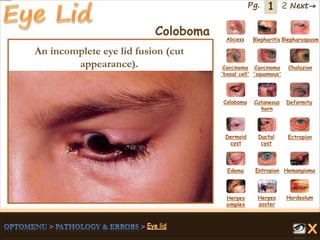 1 Next→Pg. 2
Coloboma Abcess Blepharitis Blepharospasm
Carcinoma
'basal cell'
Carcinoma
'squamous'
Chalazion
Coloboma Cutaneous
horn
Deformity
Dermoid
cyst
Ductal
cyst
Ectropion
EntropionEdema Hemangioma
Herpes
simplex
Herpes
zoster
Hordeolum
An incomplete eye lid fusion (cut
appearance).
 