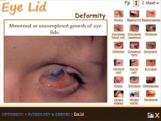 1 Next→Pg. 2
Deformity Abcess Blepharitis Blepharospasm
Carcinoma
'basal cell'
Carcinoma
'squamous'
Chalazion
Coloboma Cutaneous
horn
Deformity
Dermoid
cyst
Ductal
cyst
Ectropion
EntropionEdema Hemangioma
Herpes
simplex
Herpes
zoster
Hordeolum
Abnormal or uncompleted growth of eye
lids.
 