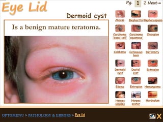 1 Next→Pg. 2
Dermoid cyst Abcess Blepharitis Blepharospasm
Carcinoma
'basal cell'
Carcinoma
'squamous'
Chalazion
Coloboma Cutaneous
horn
Deformity
Dermoid
cyst
Ductal
cyst
Ectropion
EntropionEdema Hemangioma
Herpes
simplex
Herpes
zoster
Hordeolum
Is a benign mature teratoma.
 