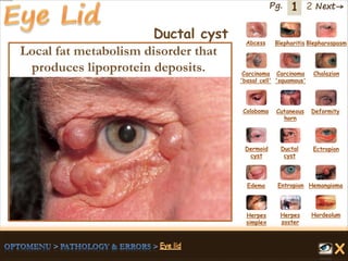 1 Next→Pg. 2
Ductal cyst Abcess Blepharitis Blepharospasm
Carcinoma
'basal cell'
Carcinoma
'squamous'
Chalazion
Coloboma Cutaneous
horn
Deformity
Dermoid
cyst
Ductal
cyst
Ectropion
EntropionEdema Hemangioma
Herpes
simplex
Herpes
zoster
Hordeolum
Local fat metabolism disorder that
produces lipoprotein deposits.
 