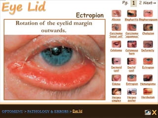 1 Next→Pg. 2
Ectropion Abcess Blepharitis Blepharospasm
Carcinoma
'basal cell'
Carcinoma
'squamous'
Chalazion
Coloboma Cutaneous
horn
Deformity
Dermoid
cyst
Ductal
cyst
Ectropion
EntropionEdema Hemangioma
Herpes
simplex
Herpes
zoster
Hordeolum
Rotation of the eyelid margin
outwards.
 