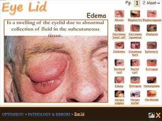 1 Next→Pg. 2
Edema Abcess Blepharitis Blepharospasm
Carcinoma
'basal cell'
Carcinoma
'squamous'
Chalazion
Coloboma Cutaneous
horn
Deformity
Dermoid
cyst
Ductal
cyst
Ectropion
EntropionEdema Hemangioma
Herpes
simplex
Herpes
zoster
Hordeolum
Is a swelling of the eyelid due to abnormal
collection of fluid in the subcutaneous
tissue.
 