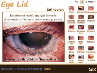 1 Next→Pg. 2
Entropion Abcess Blepharitis Blepharospasm
Carcinoma
'basal cell'
Carcinoma
'squamous'
Chalazion
Coloboma Cutaneous
horn
Deformity
Dermoid
cyst
Ductal
cyst
Ectropion
EntropionEdema Hemangioma
Herpes
simplex
Herpes
zoster
Hordeolum
Rotation of eyelid margin inwards
(There trichiasis 'Inturned lashes' in image below) .
Entropion wih trichiasis 'Inturned lashes'
 