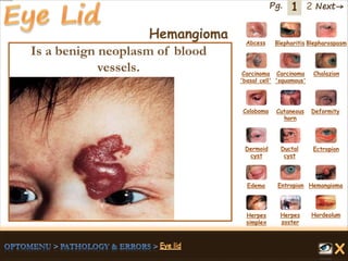 1 Next→Pg. 2
Hemangioma Abcess Blepharitis Blepharospasm
Carcinoma
'basal cell'
Carcinoma
'squamous'
Chalazion
Coloboma Cutaneous
horn
Deformity
Dermoid
cyst
Ductal
cyst
Ectropion
EntropionEdema Hemangioma
Herpes
simplex
Herpes
zoster
Hordeolum
Is a benign neoplasm of blood
vessels.
 