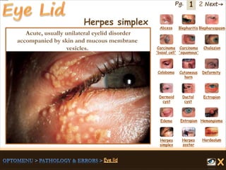 1 Next→Pg. 2
Herpes simplex Abcess Blepharitis Blepharospasm
Carcinoma
'basal cell'
Carcinoma
'squamous'
Chalazion
Coloboma Cutaneous
horn
Deformity
Dermoid
cyst
Ductal
cyst
Ectropion
EntropionEdema Hemangioma
Herpes
simplex
Herpes
zoster
Hordeolum
Acute, usually unilateral eyelid disorder
accompanied by skin and mucous membrane
vesicles.
 