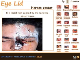 1 Next→Pg. 2
Herpes zoster Abcess Blepharitis Blepharospasm
Carcinoma
'basal cell'
Carcinoma
'squamous'
Chalazion
Coloboma Cutaneous
horn
Deformity
Dermoid
cyst
Ductal
cyst
Ectropion
EntropionEdema Hemangioma
Herpes
simplex
Herpes
zoster
Hordeolum
Is a facial rash caused by the varicella-
zoster virus.
 
