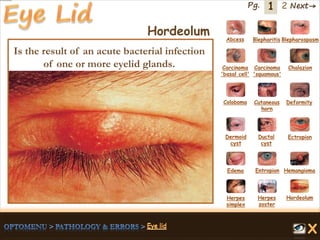 1 Next→Pg. 2
Hordeolum Abcess Blepharitis Blepharospasm
Carcinoma
'basal cell'
Carcinoma
'squamous'
Chalazion
Coloboma Cutaneous
horn
Deformity
Dermoid
cyst
Ductal
cyst
Ectropion
EntropionEdema Hemangioma
Herpes
simplex
Herpes
zoster
Hordeolum
Is the result of an acute bacterial infection
of one or more eyelid glands.
 
