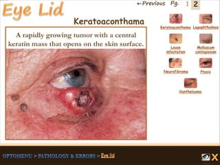 2←Previous Pg. 1
Keratoaconthama Lagophthalmos
Molluscum
contagiosum
Louse
infestation
Neurofibroma Ptosis
Xanthelasma
A rapidly growing tumor with a central
keratin mass that opens on the skin surface.
Keratoaconthama
 