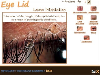 2←Previous Pg. 1
Louse infestation
Infestation of the margin of the eyelid with crab lice
as a result of poor hygienic conditions.
Keratoaconthama Lagophthalmos
Molluscum
contagiosum
Louse
infestation
Neurofibroma Ptosis
Xanthelasma
 