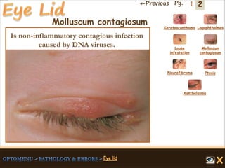 2←Previous Pg. 1
Molluscum contagiosum
Is non-inflammatory contagious infection
caused by DNA viruses.
Keratoaconthama Lagophthalmos
Molluscum
contagiosum
Louse
infestation
Neurofibroma Ptosis
Xanthelasma
 