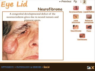 2←Previous Pg. 1
Neurofibroma
A congenital developmental defect of the
neuroectoderm gives rise to neural tumors and
pigment spots.
Keratoaconthama Lagophthalmos
Molluscum
contagiosum
Louse
infestation
Neurofibroma Ptosis
Xanthelasma
 