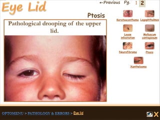 2←Previous Pg. 1
Ptosis
Pathological drooping of the upper
lid.
Keratoaconthama Lagophthalmos
Molluscum
contagiosum
Louse
infestation
Neurofibroma Ptosis
Xanthelasma
 