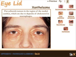 2←Previous Pg. 1
Xanthelasma
Flat yellowish tumors in the region of the medial
canthus, which are due to deposits of cholesterol in
macrophages.
Keratoaconthama Lagophthalmos
Molluscum
contagiosum
Louse
infestation
Neurofibroma Ptosis
Xanthelasma
 