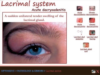 Acute
dacryoadenitis
Acute
dacryocystitis
Chronic
dacryocystitis
Lacrimal duct
anamolies
Lacrimal gland
cyst
Lacrimal duct
tearing
Chronic
dacryoadenitis
A sudden unilateral tender swelling of the
lacrimal gland.
Acute dacryoadenitis
 