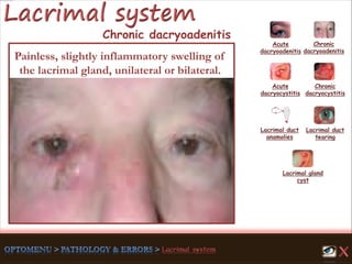 Acute
dacryoadenitis
Acute
dacryocystitis
Chronic
dacryocystitis
Lacrimal duct
anamolies
Lacrimal gland
cyst
Lacrimal duct
tearing
Chronic
dacryoadenitis
Painless, slightly inflammatory swelling of
the lacrimal gland, unilateral or bilateral.
Chronic dacryoadenitis
 