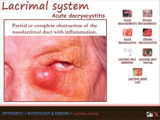 Acute
dacryoadenitis
Acute
dacryocystitis
Chronic
dacryocystitis
Lacrimal duct
anamolies
Lacrimal gland
cyst
Lacrimal duct
tearing
Chronic
dacryoadenitis
Partial or complete obstruction of the
nasolacrimal duct with inflammation.
Acute dacryocystitis
 