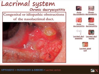 Acute
dacryoadenitis
Acute
dacryocystitis
Chronic
dacryocystitis
Lacrimal duct
anamolies
Lacrimal gland
cyst
Lacrimal duct
tearing
Chronic
dacryoadenitisCongenital or idiopathic obstructions
of the nasolacrimal duct.
Chronic dacryocystitis
 