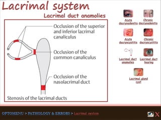 Lacrimal duct anamolies
Acute
dacryoadenitis
Acute
dacryocystitis
Chronic
dacryocystitis
Lacrimal duct
anamolies
Lacrimal gland
cyst
Lacrimal duct
tearing
Chronic
dacryoadenitis
 