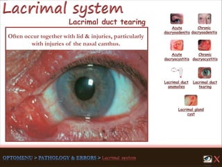 Acute
dacryoadenitis
Acute
dacryocystitis
Chronic
dacryocystitis
Lacrimal duct
anamolies
Lacrimal gland
cyst
Lacrimal duct
tearing
Chronic
dacryoadenitis
Often occur together with lid & injuries, particularly
with injuries of the nasal canthus.
Lacrimal duct tearing
 