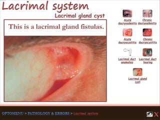 Acute
dacryoadenitis
Acute
dacryocystitis
Chronic
dacryocystitis
Lacrimal duct
anamolies
Lacrimal gland
cyst
Lacrimal duct
tearing
Chronic
dacryoadenitis
This is a lacrimal gland fistulas.
Lacrimal gland cyst
 