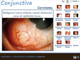 1Pg. 2 Next→
Carcinoma Conjunctival
chemosis
Conjunctival
cyst
Conjunctival
hemangioma
Conjunctival
injection
Conjunctival
xerosis
Conjunctivitis
‘Allergic’
Conjunctivitis
‘Bacterial’
Conjunctivitis
‘Epidemic
Viral’
conjunctivitis
Gonoccocal
'neonatal'
Conjunctivitis
’Papillary’
Conjunctivitis
‘Vernal’
Conjunctivitis
‘Woody’
Dermoid
Carcinoma
Malignant tumor whitish, raised, thickened
areas of epithelial tissue.
Conjunctivitis
‘Follicular’
 