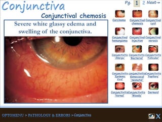 1Pg. 2 Next→
Conjunctival chemosis
Severe white glassy edema and
swelling of the conjunctiva.
Carcinoma Conjunctival
chemosis
Conjunctival
cyst
Conjunctival
hemangioma
Conjunctival
injection
Conjunctival
xerosis
Dermoid
Conjunctivitis
‘Allergic’
Conjunctivitis
‘Bacterial’
Conjunctivitis
‘Epidemic
Viral’
conjunctivitis
Gonoccocal
'neonatal'
Conjunctivitis
’Papillary’
Conjunctivitis
‘Vernal’
Conjunctivitis
‘Woody’
Conjunctivitis
‘Follicular’
 