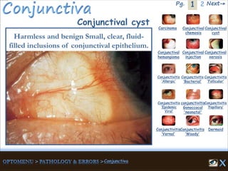 1Pg. 2 Next→
Conjunctival cyst Carcinoma Conjunctival
chemosis
Conjunctival
cyst
Conjunctival
hemangioma
Conjunctival
injection
Conjunctival
xerosis
Dermoid
Conjunctivitis
‘Allergic’
Conjunctivitis
‘Bacterial’
Conjunctivitis
‘Epidemic
Viral’
conjunctivitis
Gonoccocal
'neonatal'
Conjunctivitis
’Papillary’
Conjunctivitis
‘Vernal’
Conjunctivitis
‘Woody’
Conjunctivitis
‘Follicular’
Harmless and benign Small, clear, fluid-
filled inclusions of conjunctival epithelium.
 