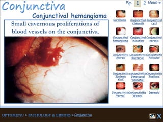 1Pg. 2 Next→
Conjunctival hemangioma
Small cavernous proliferations of
blood vessels on the conjunctiva.
Carcinoma Conjunctival
chemosis
Conjunctival
cyst
Conjunctival
hemangioma
Conjunctival
injection
Conjunctival
xerosis
Dermoid
Conjunctivitis
‘Allergic’
Conjunctivitis
‘Bacterial’
Conjunctivitis
‘Epidemic
Viral’
conjunctivitis
Gonoccocal
'neonatal'
Conjunctivitis
’Papillary’
Conjunctivitis
‘Vernal’
Conjunctivitis
‘Woody’
Conjunctivitis
‘Follicular’
 