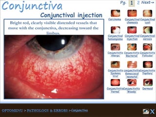 1Pg. 2 Next→
Conjunctival injection
Bright red, clearly visible distended vessels that
move with the conjunctiva, decreasing toward the
limbus.
Carcinoma Conjunctival
chemosis
Conjunctival
cyst
Conjunctival
hemangioma
Conjunctival
injection
Conjunctival
xerosis
Dermoid
Conjunctivitis
‘Allergic’
Conjunctivitis
‘Bacterial’
Conjunctivitis
‘Epidemic
Viral’
conjunctivitis
Gonoccocal
'neonatal'
Conjunctivitis
’Papillary’
Conjunctivitis
‘Vernal’
Conjunctivitis
‘Woody’
Conjunctivitis
‘Follicular’
 