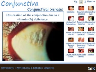 1Pg. 2 Next→
Conjunctival xerosis Carcinoma Conjunctival
chemosis
Conjunctival
cyst
Conjunctival
hemangioma
Conjunctival
injection
Conjunctival
xerosis
Dermoid
Conjunctivitis
‘Allergic’
Conjunctivitis
‘Bacterial’
Conjunctivitis
‘Epidemic
Viral’
conjunctivitis
Gonoccocal
'neonatal'
Conjunctivitis
’Papillary’
Conjunctivitis
‘Vernal’
Conjunctivitis
‘Woody’
Conjunctivitis
‘Follicular’
Desiccation of the conjunctiva due to a
vitamin (A) deficiency.
 